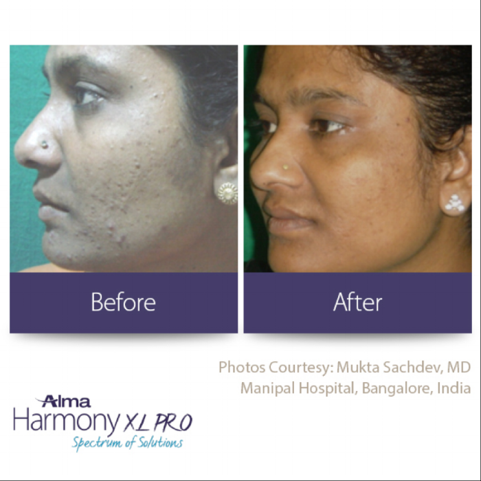 Acne Laser Treatments – Acne Clear Laser – My Beauty Doctor